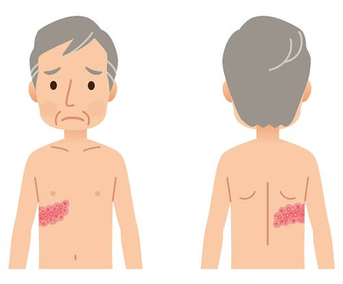 痛みの後にプツプツ(疱疹)が出る帯状疱疹